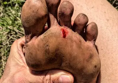 Gallery of foot injuries caused by running barefoot across Britain.
